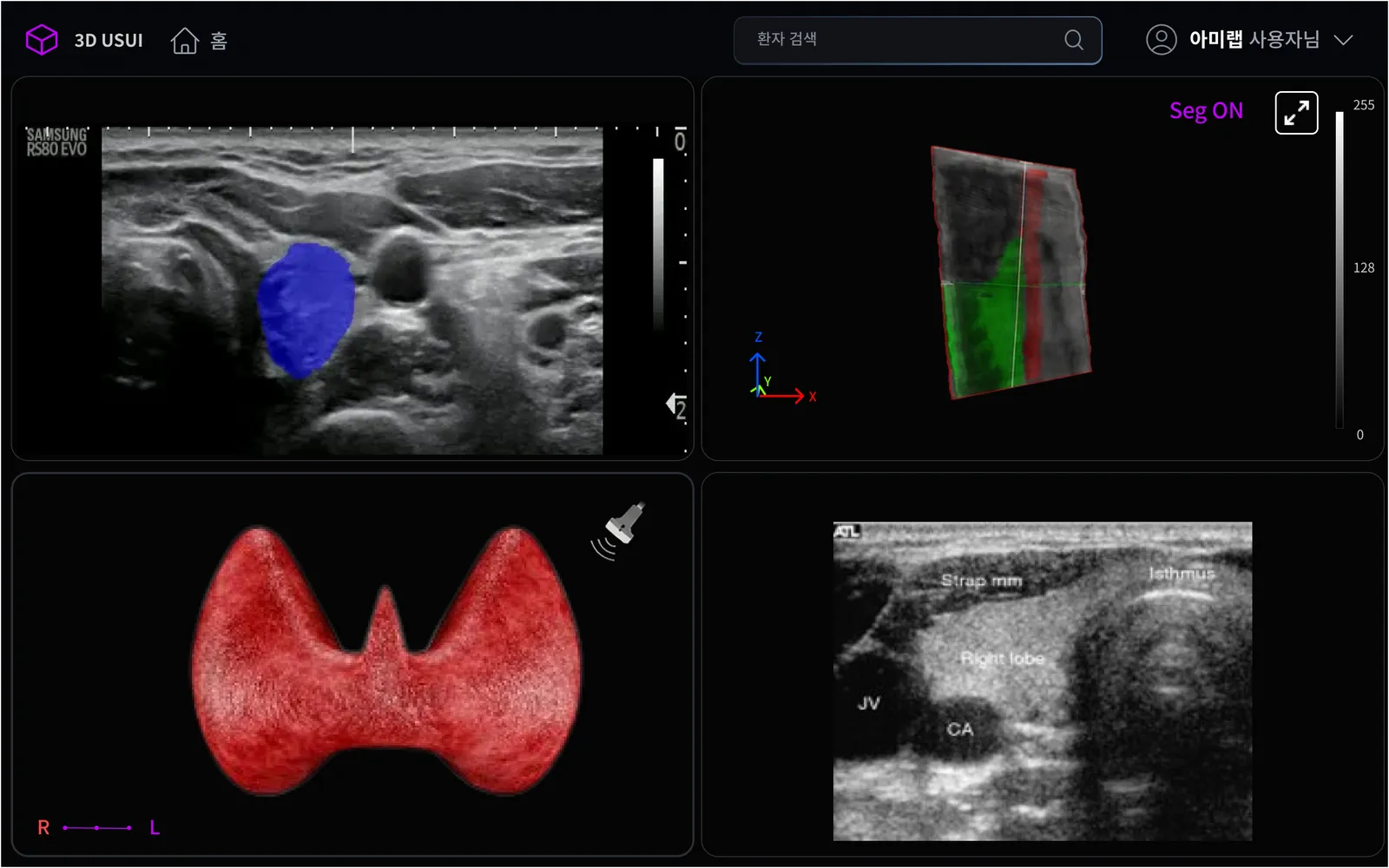 3D 초음파 AI 진단 시스템 화면